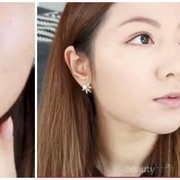 #FORUM Bisa Gak Concealer Menutupi Jerawat Batu?