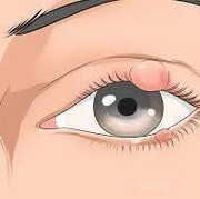 Gimana sih cara atasi mata bintitan? share yuk !