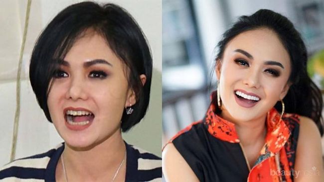 Lihat Perbedaannya! Ini Dia 7 Foto Before and After Artis yang Lakukan