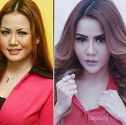 Mengejutkan! 10 Wajah Artis Ini Berubah Drastis Setelah Operasi Plastik