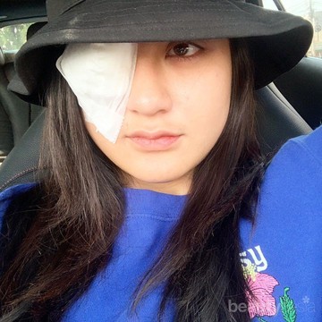 Nyaris Buta, Salshabilla Adriani Alami Infeksi Kornea Gara-Gara Softlens