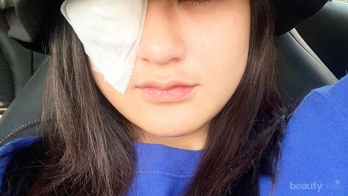Nyaris Buta, Salshabilla Adriani Alami Infeksi Kornea Gara-Gara Softlens