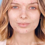 #FORUM Jerawat Itu Menular Gak Sih Kak??