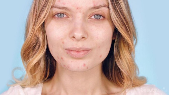 #FORUM Jerawat Itu Menular Gak Sih Kak??