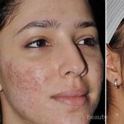 #FORUM Gimana Cara Menghilangkan Bekas Jerawat?