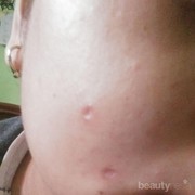 [FORUM] Cara Menghilangkan bopeng bekas cacar/jerawat
