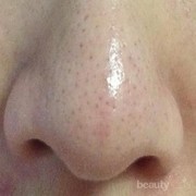 #FORUM Rekomendasi Produk untuk Menghilangkan Komedo