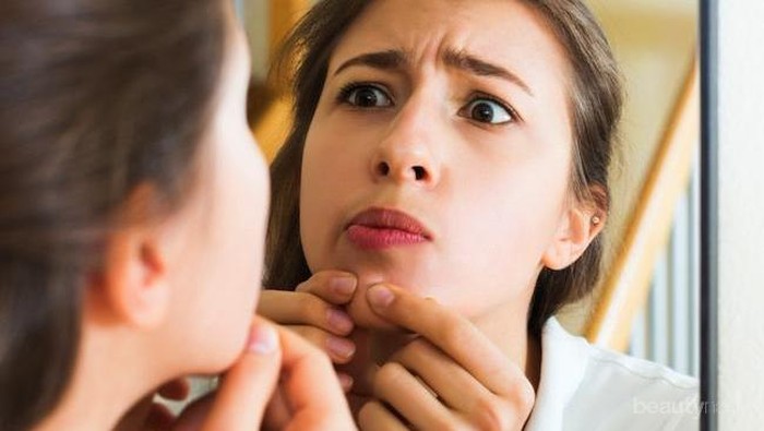 Terapkan Teknik Memencet Jerawat Seperti Ini Agar Tidak Meninggalkan Bekas Menghitam di Wajah!