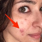 Apakah Albothyl Bisa Dipakai Menghilangkan Jerawat?