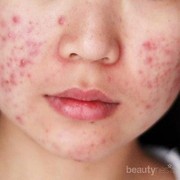 #FORUM Produk Apa yang Ampuh Untuk Menghilangkan Jerawat Setelah Berhenti Pakai Skincare Mahal?