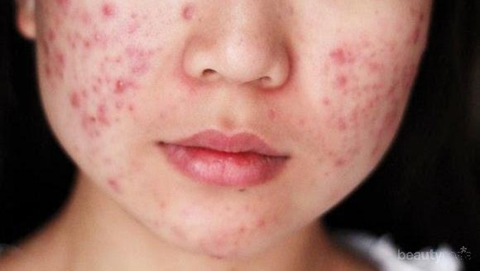 #FORUM Produk Apa yang Ampuh Untuk Menghilangkan Jerawat Setelah Berhenti Pakai Skincare Mahal? #FORUM Produk Apa yang Ampuh Untuk Menghilangkan Jerawat Setelah Berhenti Pakai Skincare Mahal?