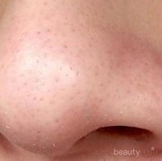 #FORUM Apa Penyebab Komedo Putih di Hidung?