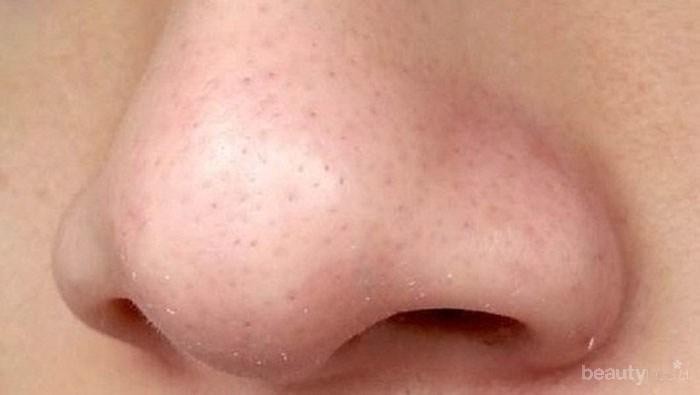 #FORUM Apa Penyebab Komedo Putih di Hidung?