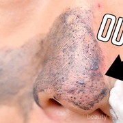 Serupa Tapi Tak Sama, Ini Dia Perbedaan Komedo Hitam dan Komedo Putih