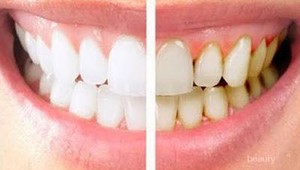 Cegah Plak Gigi Sedini Mungkin, dengan Melakukan Kebiasaan Ini