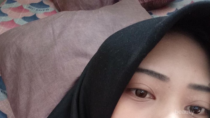 #FORUM Share pengalaman kulit gak berjerawat tapi bermata panda plus komedoan dan berminyak