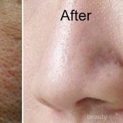 #FORUM Bagaimana Cara Menghilangkan Pori-Pori di Wajah?? Help!!