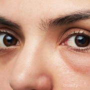 Memiliki Puffy Eyes? Berikut Cara Ampuh Mengatasinya!