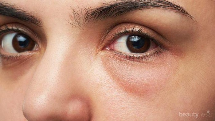 Memiliki Puffy Eyes? Berikut Cara Ampuh Mengatasinya!