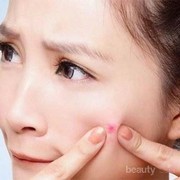 4 Cara Ampuh Hilangkan Noda Bekas Jerawat dengan Cepat