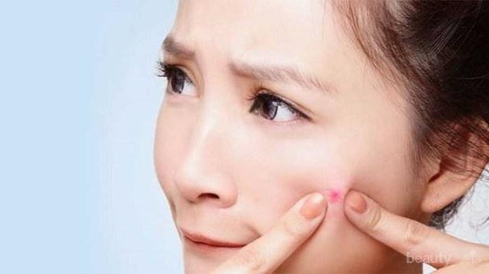 4 Cara Ampuh Hilangkan Noda Bekas Jerawat dengan Cepat