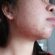 #FORUM Gimana sih Cara Menghilangkan Jerawat dan Bekas Jerawat yang Kemerahan?