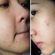 Ada yang Tau Cara Menghilangkan Biang Keringat di Wajah?