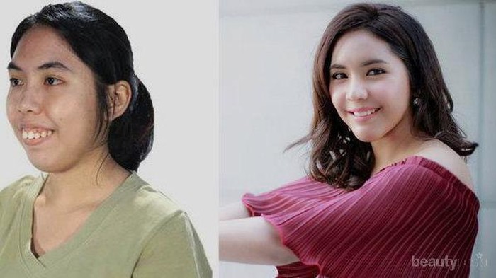 Ternyata Ini Alasan Wanita Korea Hobi Melakukan Operasi Plastik Berulang Kali! Ternyata Ini Alasan Wanita Korea Hobi Melakukan Operasi Plastik Berulang Kali!