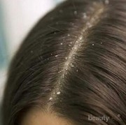 [FORUM] Shampoo Untuk Ketombe yang Bagus Apa ya?