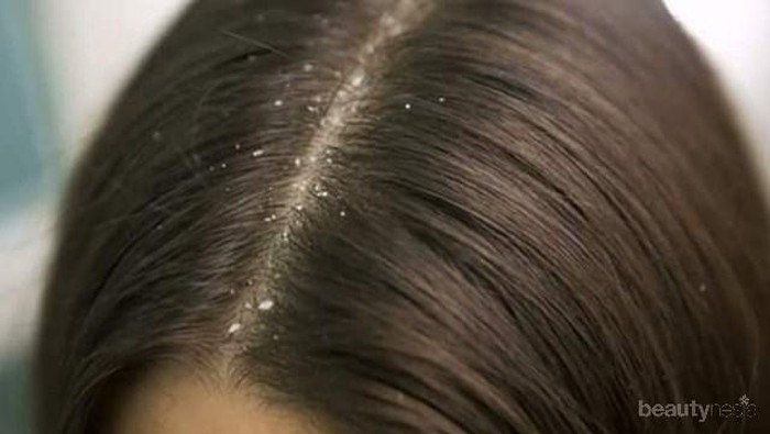 [FORUM] Shampoo Untuk Ketombe yang Bagus Apa ya?