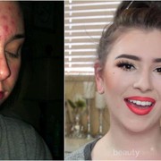 Apakah Bopeng Bekas Jerawat Bisa Dihilangkan dengan Menggunakan Krim Saja?