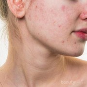 Cara Sederhana Rawat Kulit Berjerawatmu dengan Produk Lokal