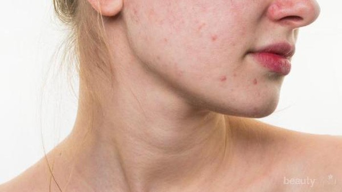 Cara Sederhana Rawat Kulit Berjerawatmu dengan Produk Lokal