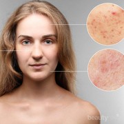 Gak Langsung Mulus, Skincare Ini Bisa Bikin Kulit Purging Terlebih Dahulu