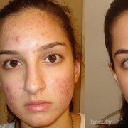 Bagaimana Cara Menghilangkan Bekas Jerawat dalam Waktu 1 Hari??? Help Me..