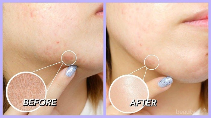 Penting! Ini Langkah Pertolongan Pertama pada Jerawat yang Pecah