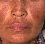 #FORUM Setelah pakai hydroquinone kulit justru menggelap? Stop pemakaian atau tetap teruskan?