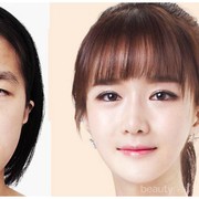 #FORUM Dear Ladies, Ada yang Tau Biaya Operasi Kelopak Mata?? Sakit Gak??