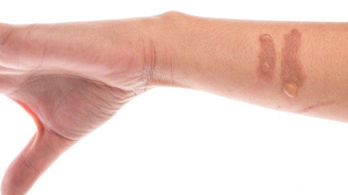 Selain Bahan Masakan, Bumbu Dapur Alami Ini Ampuh Hilangkan Bekas Luka!