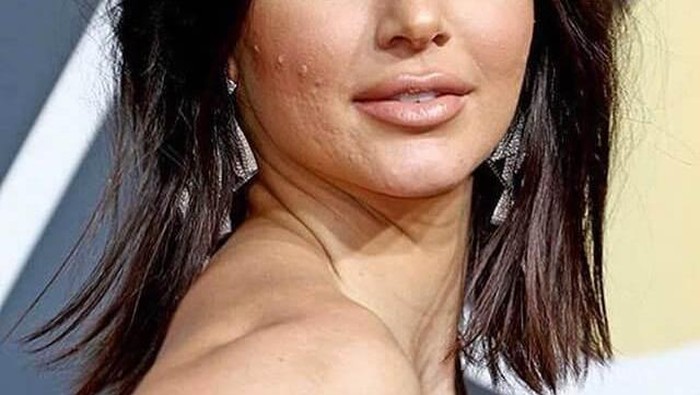 Ladies, Produk Apa yang Bisa Menghilangkan Bekas Jerawat Membandel Ya?