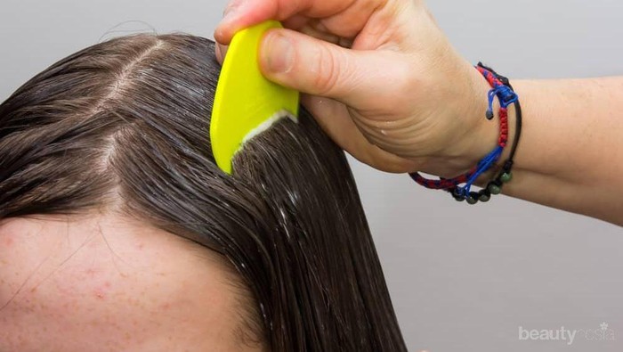 Bagaimana Cara Mengatasi Kutu Rambut??? Ada yang Tau?? Bagaimana Cara Mengatasi Kutu Rambut??? Ada yang Tau??