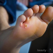 Dear.. Gimana Sih Cara Menghilangkan Mata Ikan di Kaki? Help me..