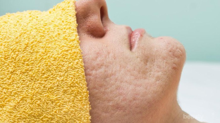 #FORUM Apa Produk yang efektif untuk Menghilangkan Luka dan Bekas Jerawat??