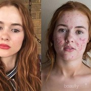 Jerawat Itu Bisa Hilang Dengan Sendirinya Gak Sih Ladies?