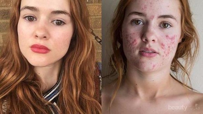 Jerawat Itu Bisa Hilang Dengan Sendirinya Gak Sih Ladies? Jerawat Itu Bisa Hilang Dengan Sendirinya Gak Sih Ladies?