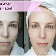 Meskipun Terkenal Menyeramkan, Ini Alasan Mengapa Vampire Facial Masih Saja Dilakukan Wanita