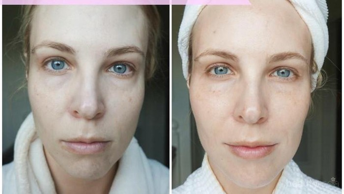 Meskipun Terkenal Menyeramkan, Ini Alasan Mengapa Vampire Facial Masih Saja Dilakukan Wanita