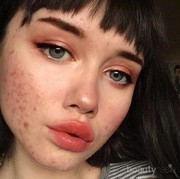 Amazing! Perempuan Ini Tetep Pede Selfie dengan Jerawat yang Telah Ia Derita 11 Tahun! Patut Dicontoh Nih!