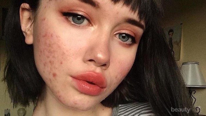 Amazing! Perempuan Ini Tetep Pede Selfie dengan Jerawat yang Telah Ia Derita 11 Tahun! Patut Dicontoh Nih! Amazing! Perempuan Ini Tetep Pede Selfie dengan Jerawat yang Telah Ia Derita 11 Tahun! Patut Dicontoh Nih!