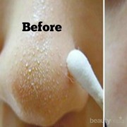 #FORUM Apakah Komedo Boleh Dipencet?? Lalu Bagaimana Cara Menghilangkannya??